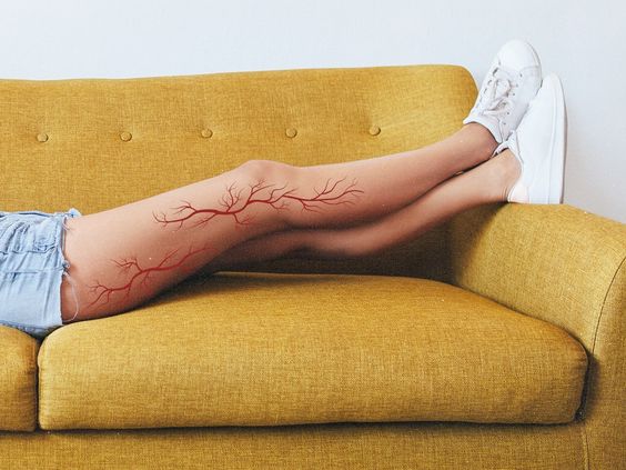 Varicose Vein Treatment Options